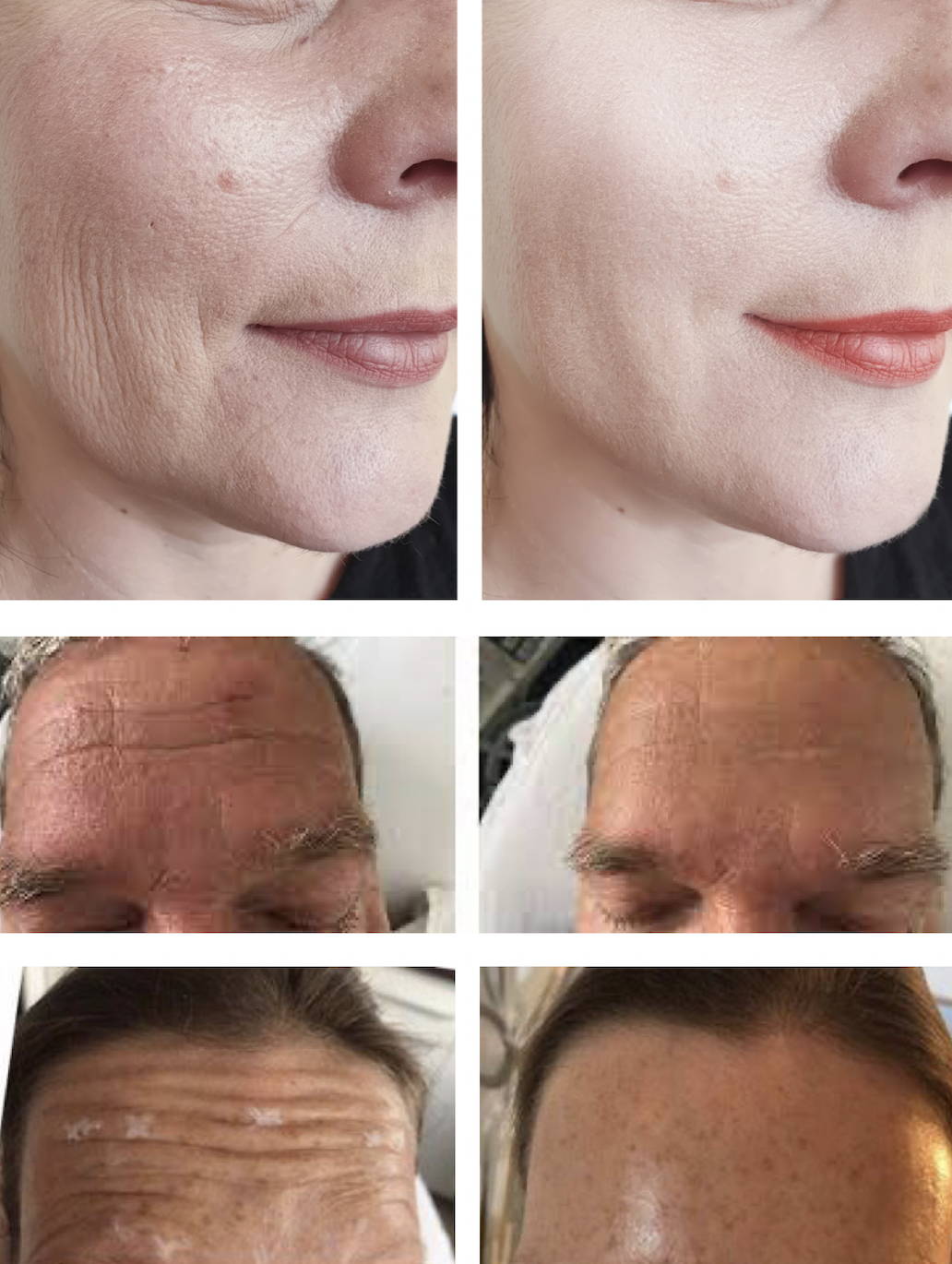 Retinol Botox Alternative DULEXIR®